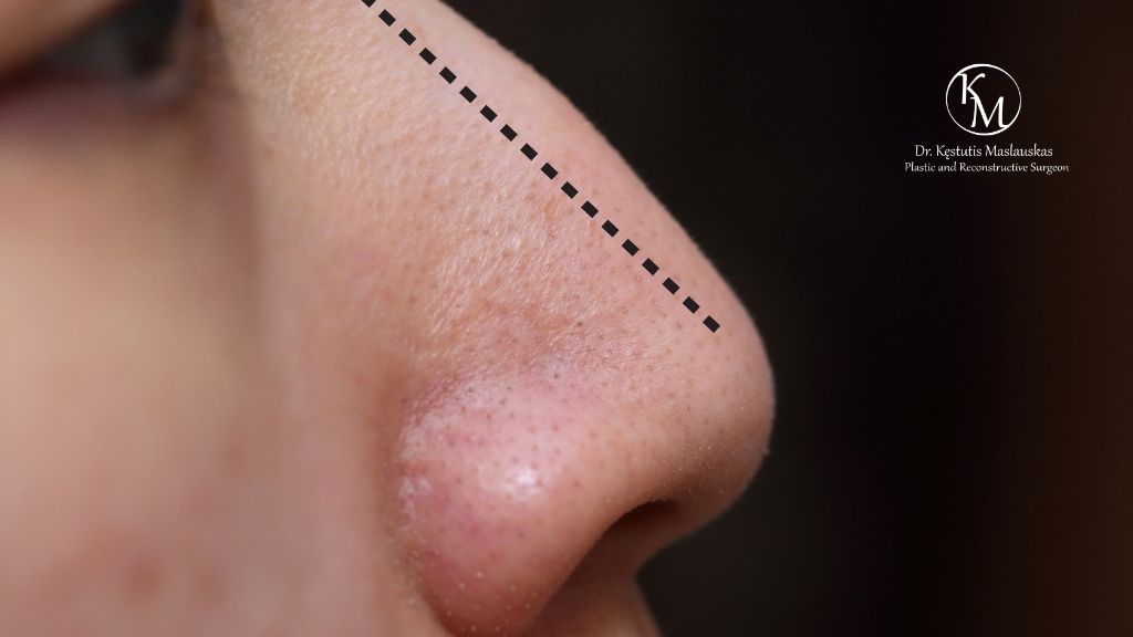 Nosies plastinė operacija pirmą kartą: kaip išvengti dažniausių pacientų nusivylimų?